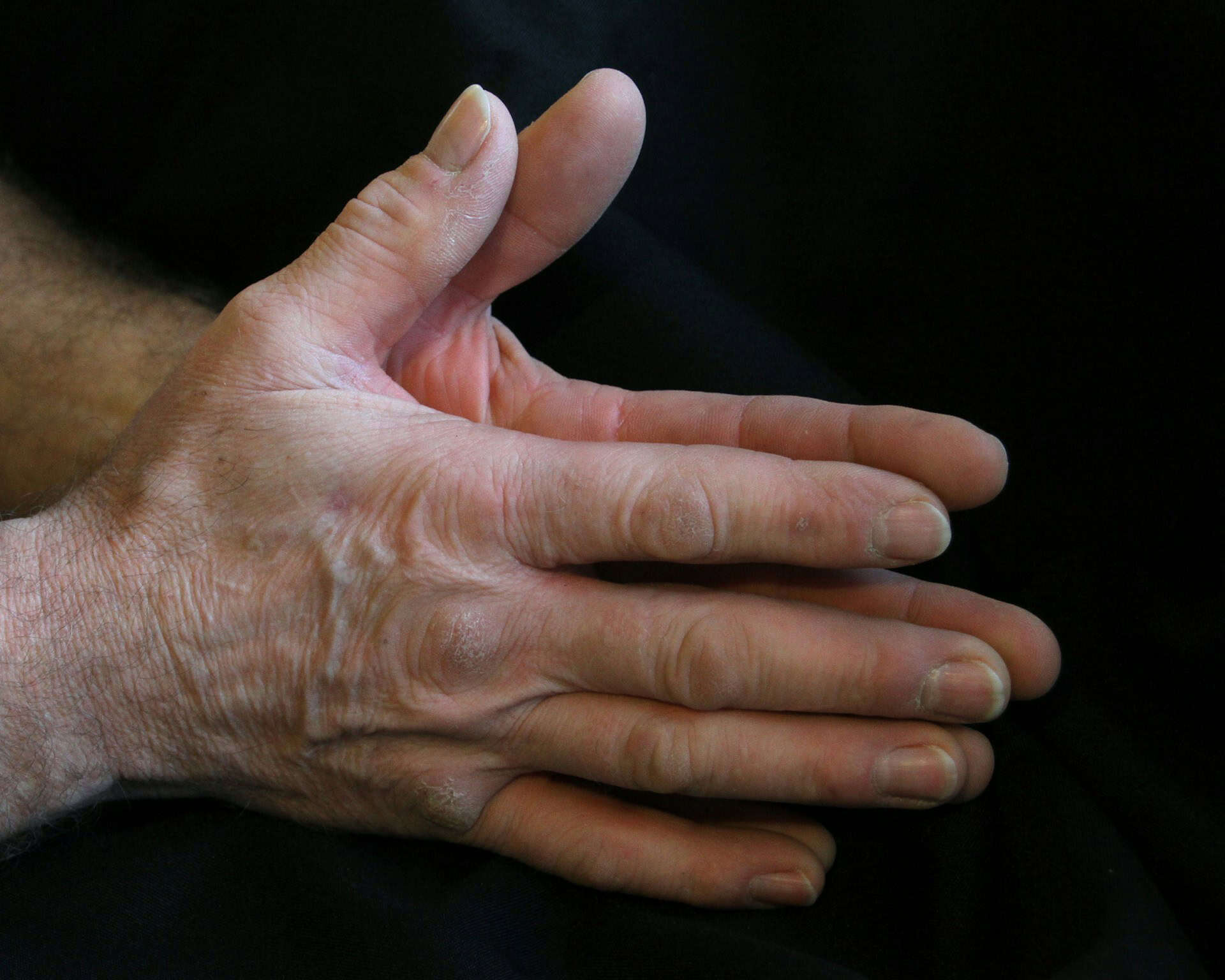 diabetic nerve pain